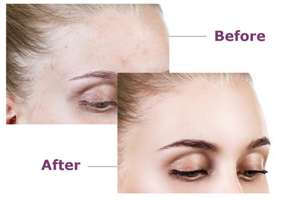 🩹 Invisible Acne Healing Patches (36 Stickers) لصقات حب الشباب الخفية (٣٦ قطعة)