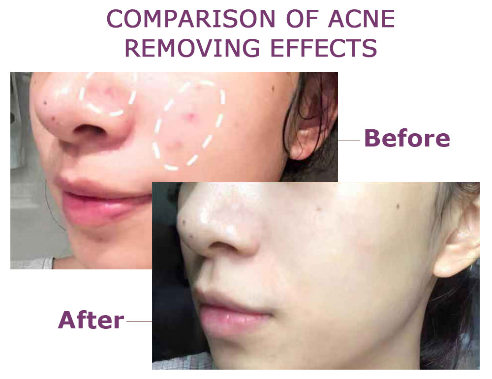 🩹 Invisible Acne Healing Patches (36 Stickers) لصقات حب الشباب الخفية (٣٦ قطعة)