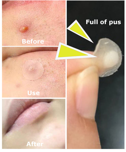 🩹 Invisible Acne Healing Patches (36 Stickers) لصقات حب الشباب الخفية (٣٦ قطعة)